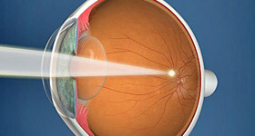 A visual explanation of short-sightedness