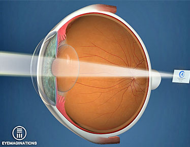 laser eye surgery technique presbyopia can fix ageing eyes