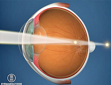 diagram of eye condition Astigmatism