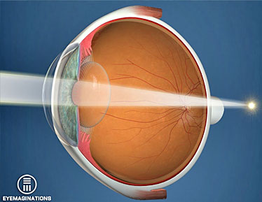 hyperopia long-sightedness