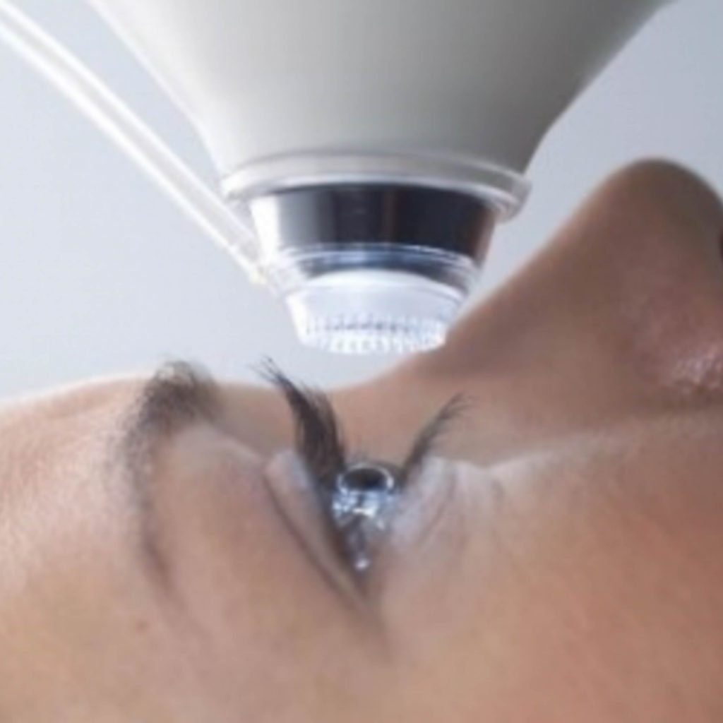 laser eye surgery procedure