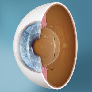 What happens if I’m not suitable for Laser Eye Surgery?