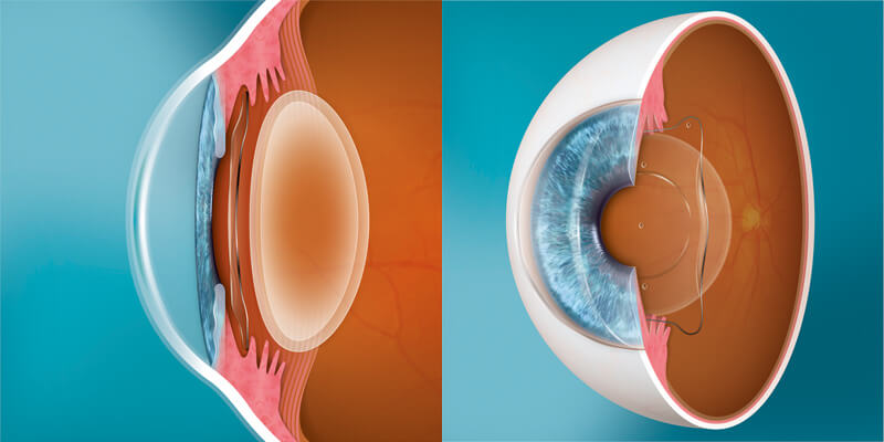 What is the difference between ICL surgery and Clear Lens Exchange?